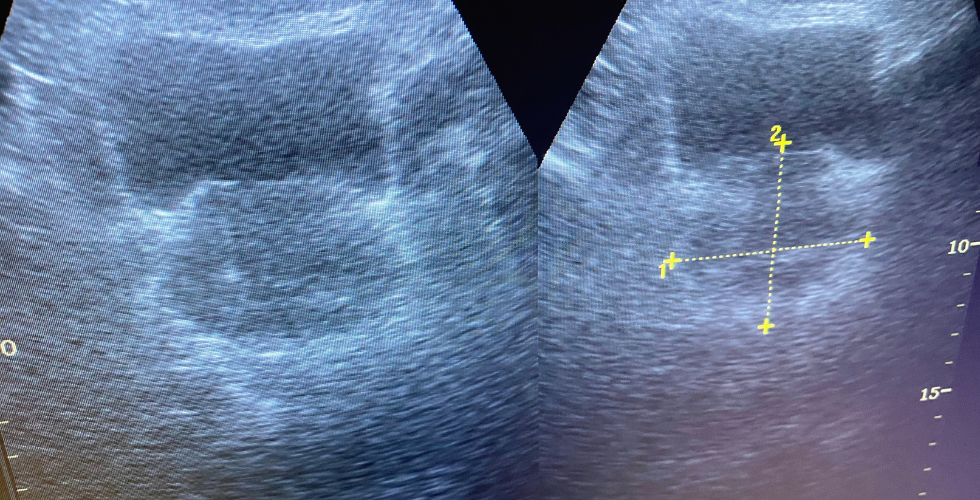 Treatment of prostate conditions considering male sexual health.