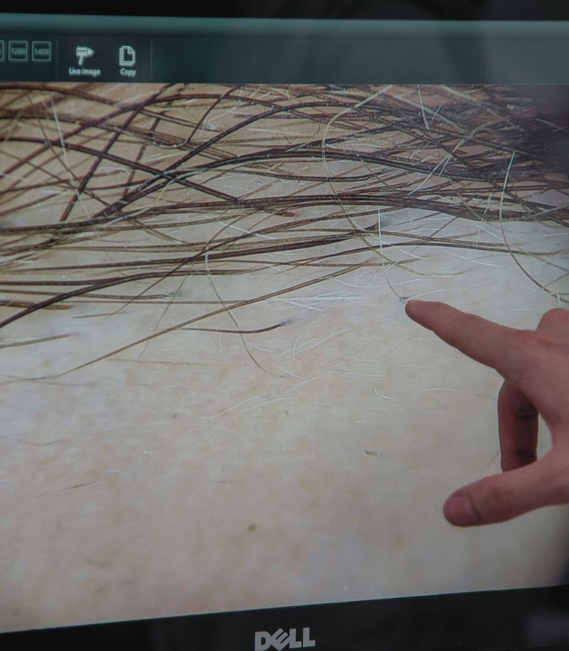 Soluciones cosméticas avanzadas para mejorar la alopecia en cejas Soluciones cosméticas avanzadas para mejorar la alopecia en cejas