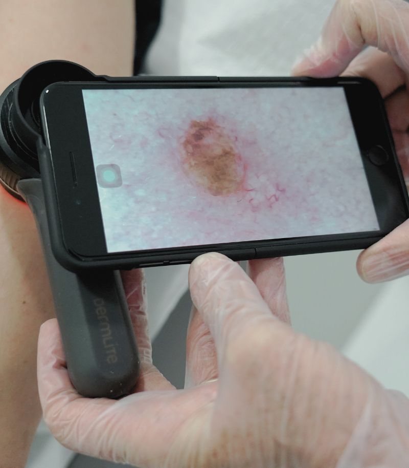 Early detection of basal cell carcinoma to avoid aggressive treatments Early detection of basal cell carcinoma to avoid aggressive treatments