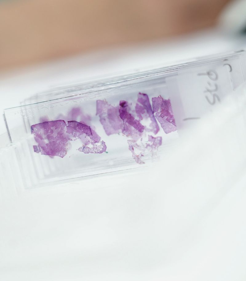 Personalised treatments for basal cell carcinoma based on location and size Personalised treatments for basal cell carcinoma based on location and size