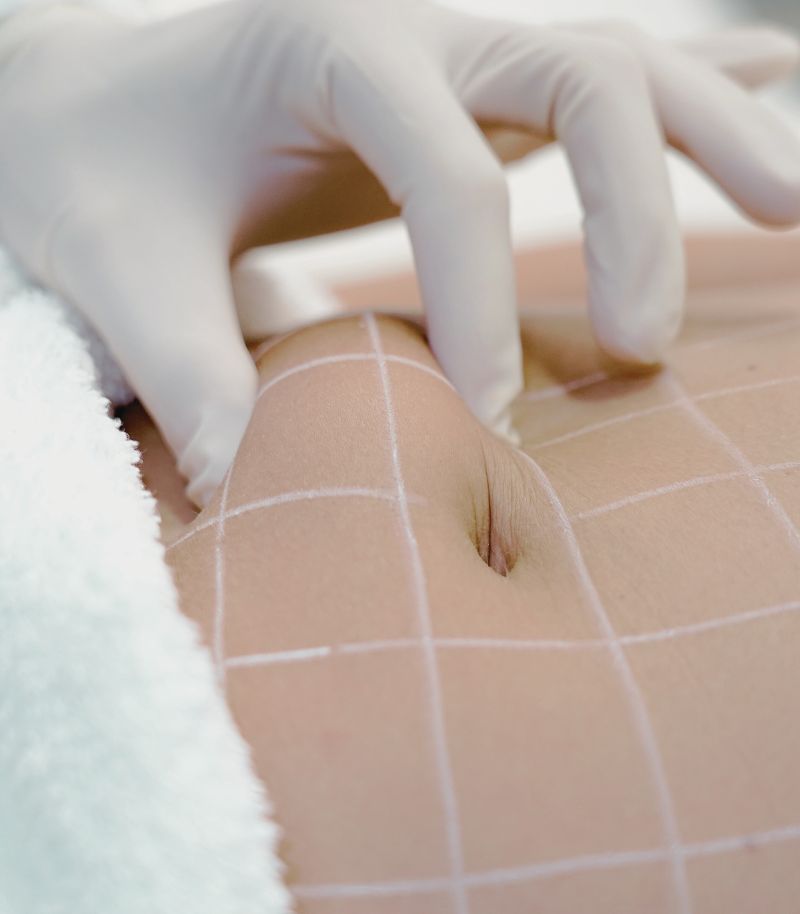 Técnicas quirúrgicas avanzadas para remodelar el abdomen con resultados naturales