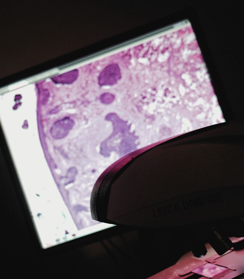 Effective removal of skin tumours through Mohs surgery in a single surgical procedure