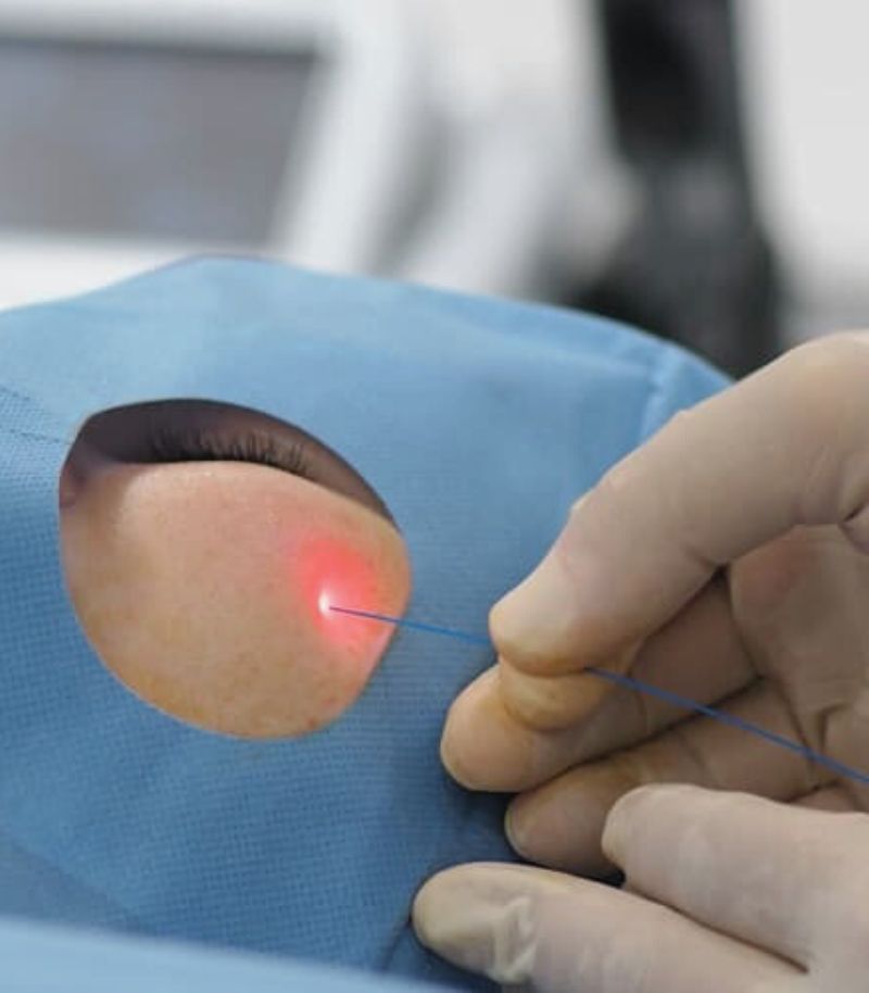 : Corrección de rellenos previos con técnicas seguras para recuperar la naturalidad : Corrección de rellenos previos con técnicas seguras para recuperar la naturalidad