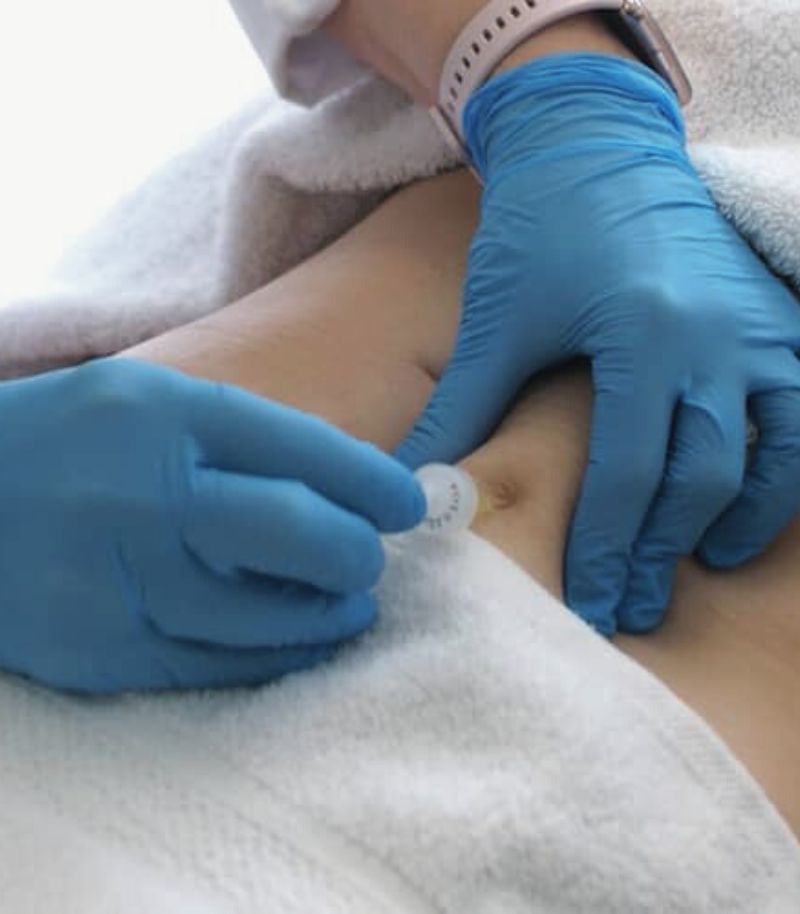 Criolipólisis combinada con radiofrecuencia, mesoterapia o carboxiterapia para resultados más completos Criolipólisis combinada con radiofrecuencia, mesoterapia o carboxiterapia para resultados más completos