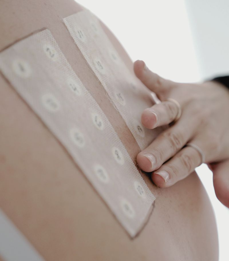 Pruebas epicutáneas para identificar alérgenos en dermatitis de contacto Pruebas epicutáneas para identificar alérgenos en dermatitis de contacto