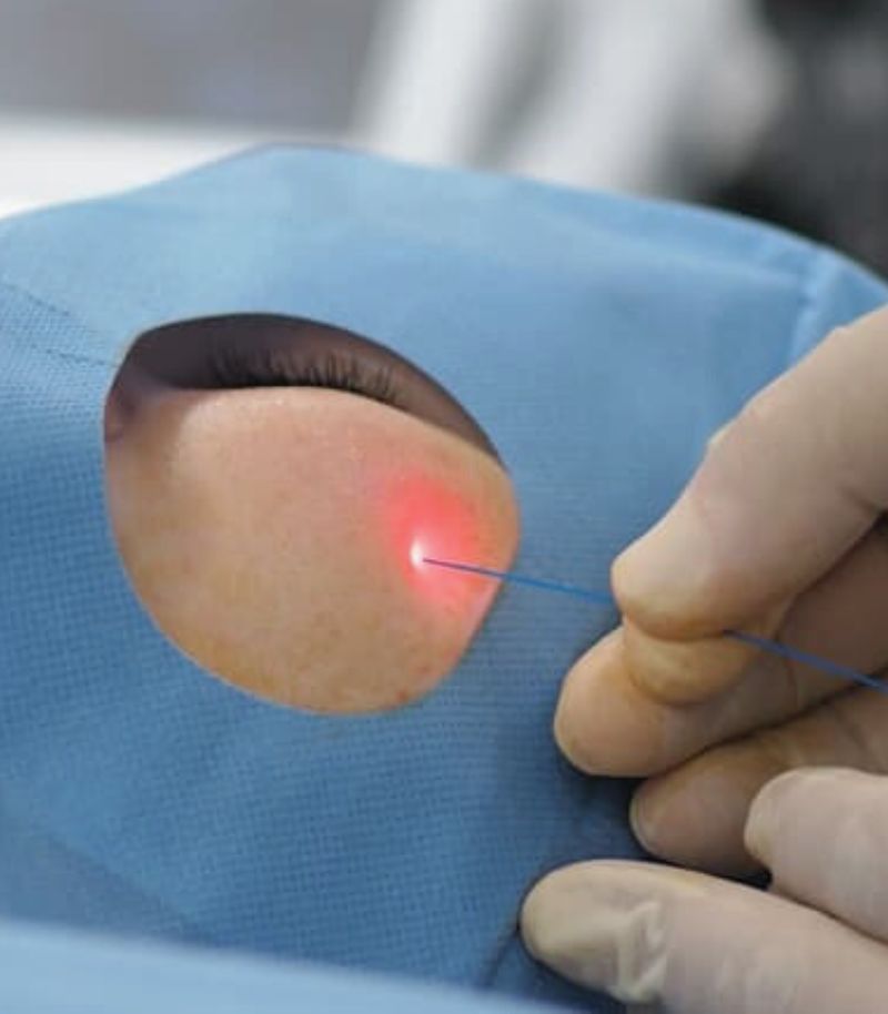 Tecnología láser para eliminar sustancias permanentes de forma segura Tecnología láser para eliminar sustancias permanentes de forma segura