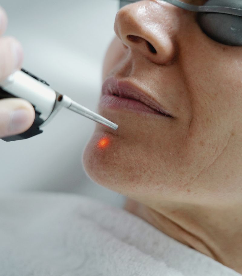 Láser de picosegundos para eliminar pigmentaciones faciales con máxima precisión Láser de picosegundos para eliminar pigmentaciones faciales con máxima precisión