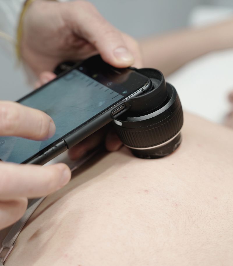 Diagnóstico precoz del melanoma mediante tecnologías como Vectra 360 y dermatoscopia digital Diagnóstico precoz del melanoma mediante tecnologías como Vectra 360 y dermatoscopia digital