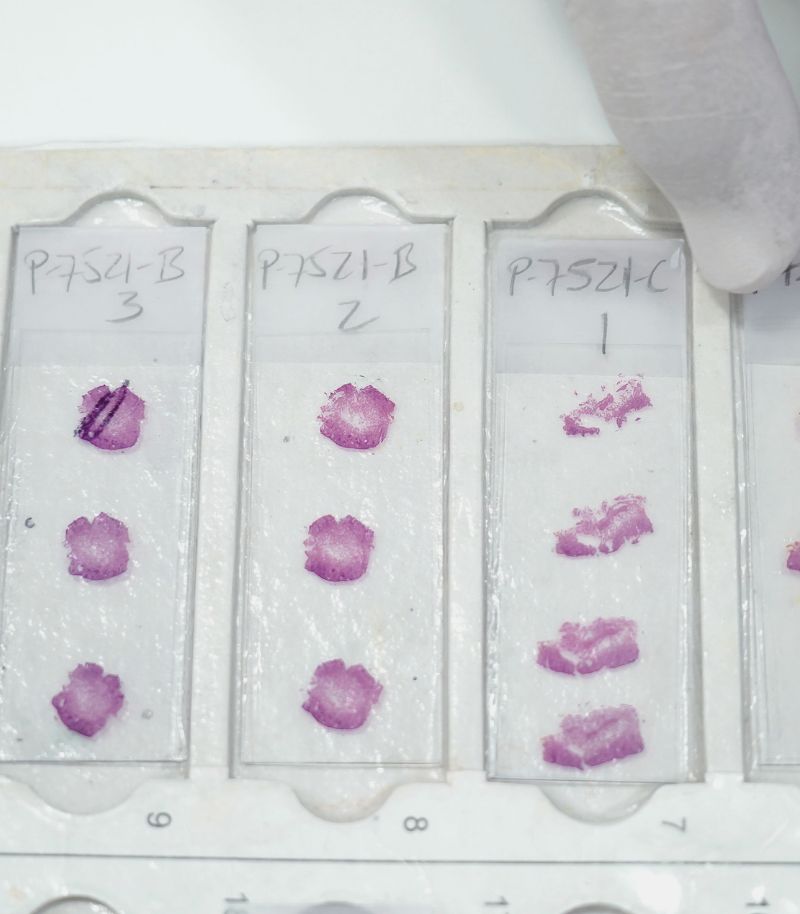 Acceso a tratamientos innovadores y ensayos clínicos en melanoma avanzado Acceso a tratamientos innovadores y ensayos clínicos en melanoma avanzado