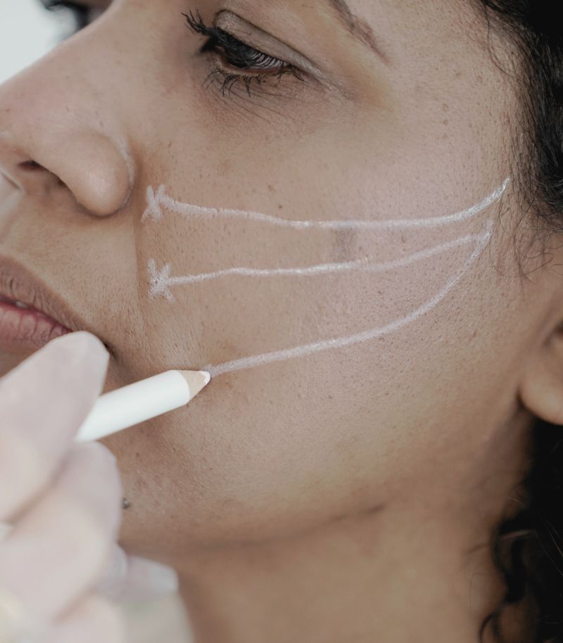 Resultados duraderos y naturales con microlifting mínimamente invasivo Resultados duraderos y naturales con microlifting mínimamente invasivo
