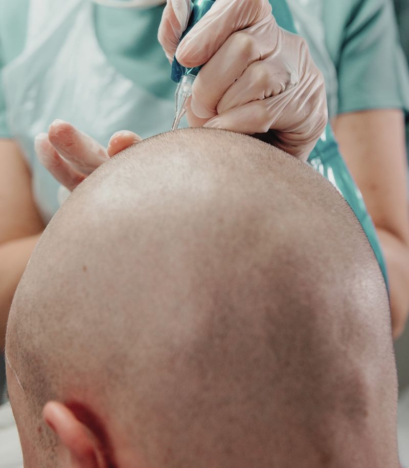 Técnica mínimamente invasiva para simular densidad capilar mediante micropigmentación Técnica mínimamente invasiva para simular densidad capilar mediante micropigmentación