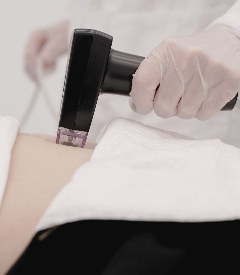 Tratamiento de flacidez con radiofrecuencia y microagujas para estimular colágeno
