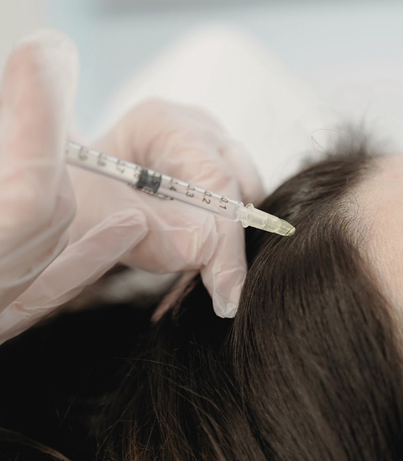 Estimulación capilar y apoyo regenerativo en tratamientos de alopecia o trasplante Estimulación capilar y apoyo regenerativo en tratamientos de alopecia o trasplante