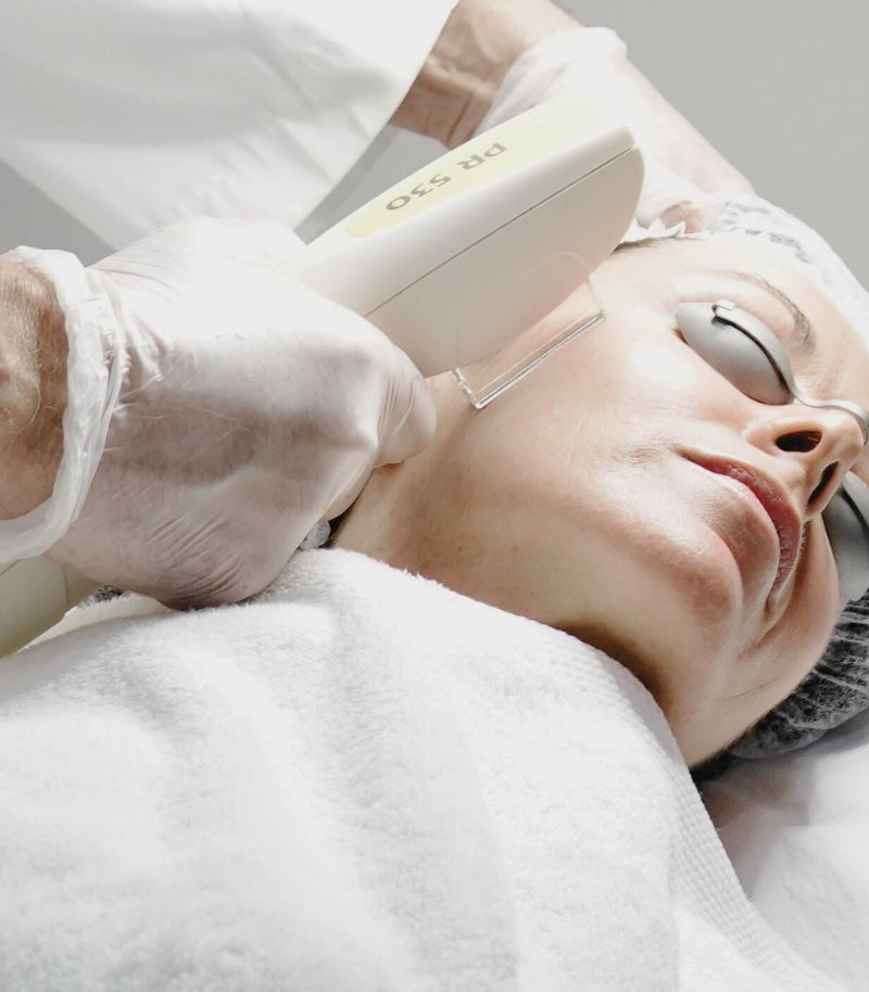 Tratamiento de rosácea con luz pulsada intensa y láser vascular de última generación Tratamiento de rosácea con luz pulsada intensa y láser vascular de última generación