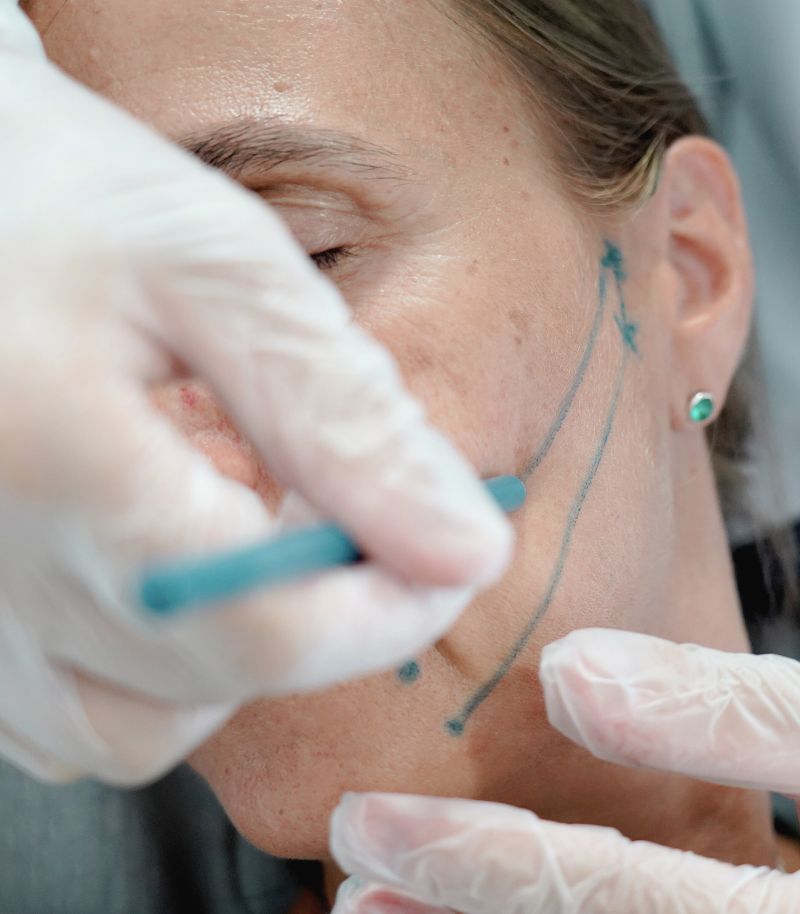 Tensado cutáneo con efecto tensor inmediato y progresivo para rejuvenecer sin cirugía