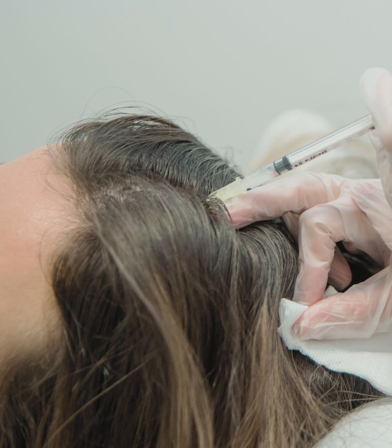 Tratamientos capilares específicos para mujeres con alopecia Tratamientos capilares específicos para mujeres con alopecia