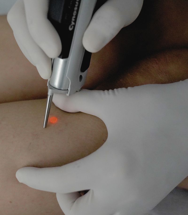 Tratamientos específicos para angiomas en zonas sensibles del cuerpo Tratamientos específicos para angiomas en zonas sensibles del cuerpo