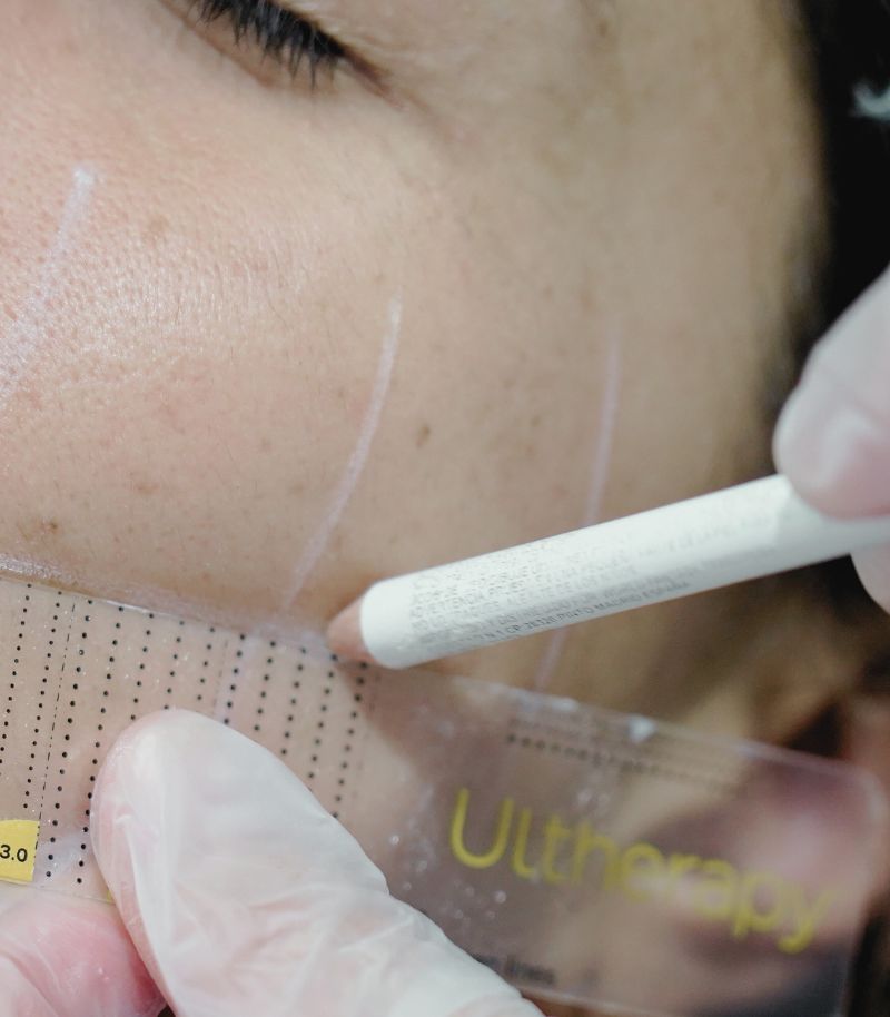 Rejuvenecimiento facial sin cirugía con Ultherapy: tensado profundo y natural Rejuvenecimiento facial sin cirugía con Ultherapy: tensado profundo y natural