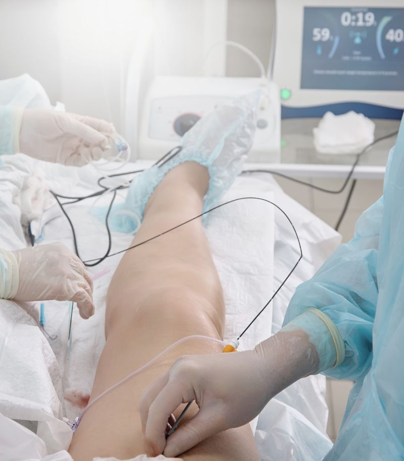 Eliminación de varices gruesas con cirugía mínimamente invasiva y recuperación rápida Eliminación de varices gruesas con cirugía mínimamente invasiva y recuperación rápida