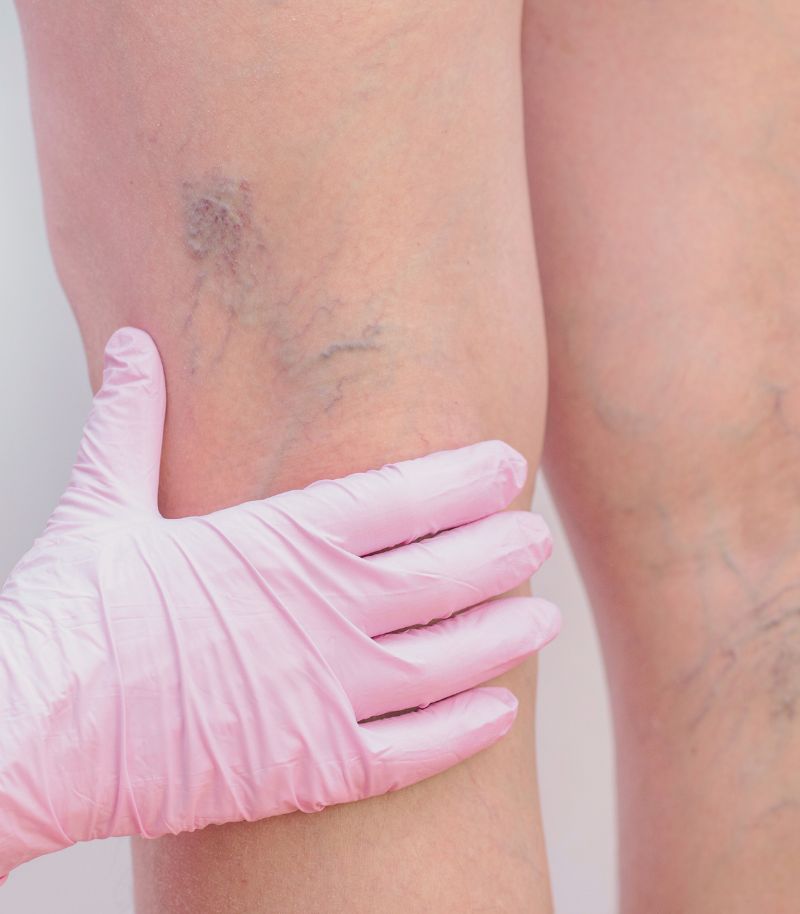 Tratamiento vascular integral con apoyo de unidades especializadas y estética corporal Tratamiento vascular integral con apoyo de unidades especializadas y estética corporal