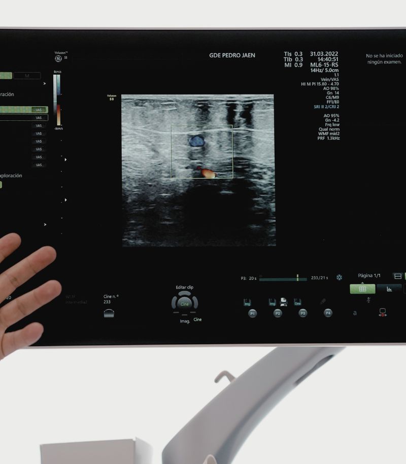 Diagnóstico vascular con ecografía Doppler y estrategia personalizada para varices Diagnóstico vascular con ecografía Doppler y estrategia personalizada para varices