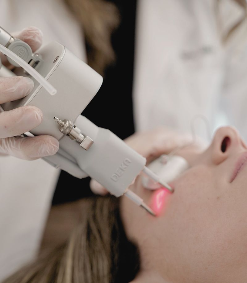 Tratamiento de cicatrices de acné con protocolo combinado de láser subcutáneo y radiofrecuencia Tratamiento de cicatrices de acné con protocolo combinado de láser subcutáneo y radiofrecuencia