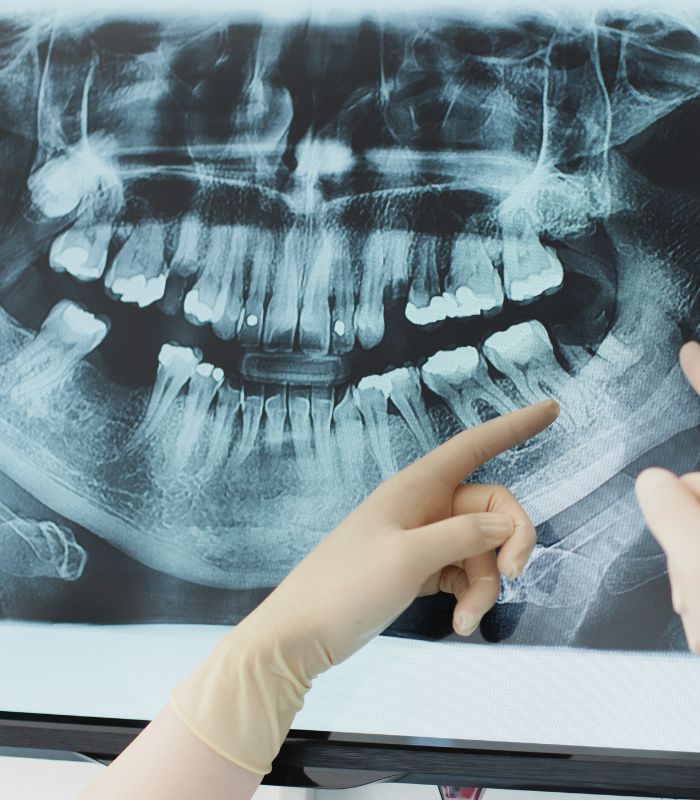 Injertos óseos y elevación de seno maxilar para casos complejos de implantología