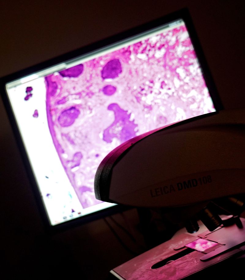 Pathology for skin cancer diagnosis Pathology for skin cancer diagnosis