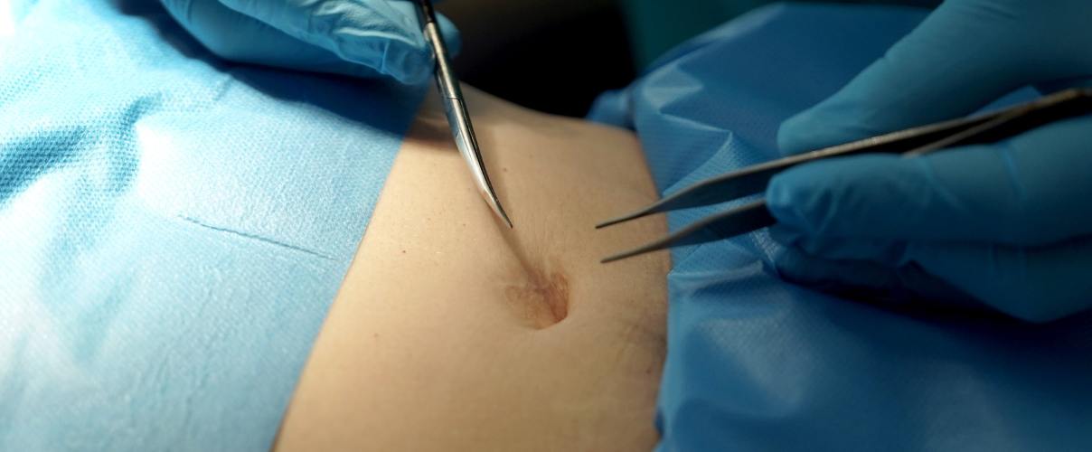 Información sobre la cirugía de liposucción Información sobre la cirugía de liposucción.