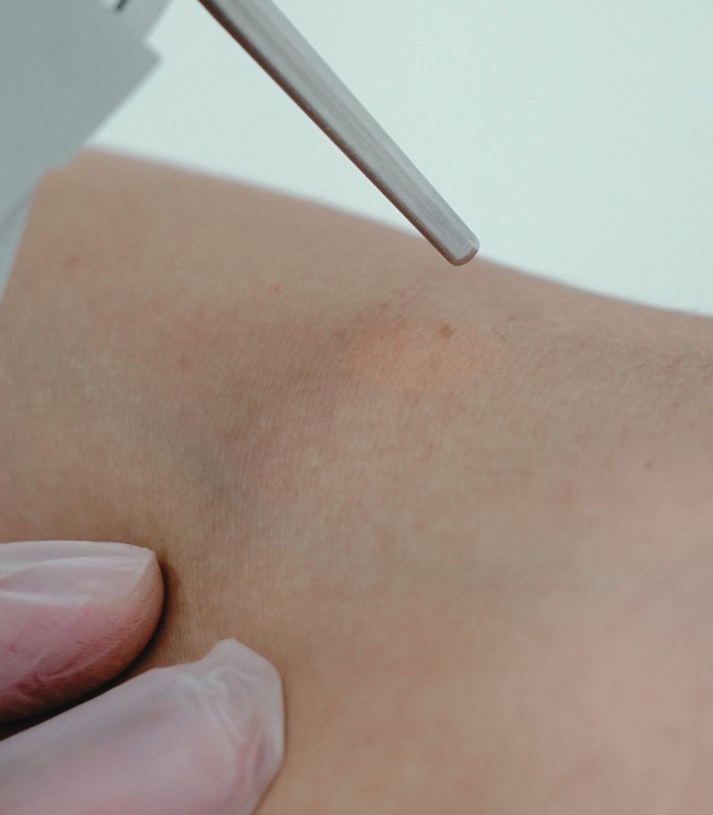 Tecnología láser avanzada para tratar manchas vasculares o pigmentarias congénitas Tecnología láser avanzada para tratar manchas vasculares o pigmentarias congénitas