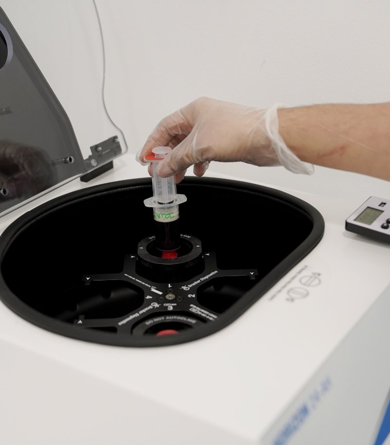 Lipofilling para rellenar zonas faciales o corporales con grasa del propio paciente Lipofilling para rellenar zonas faciales o corporales con grasa del propio paciente