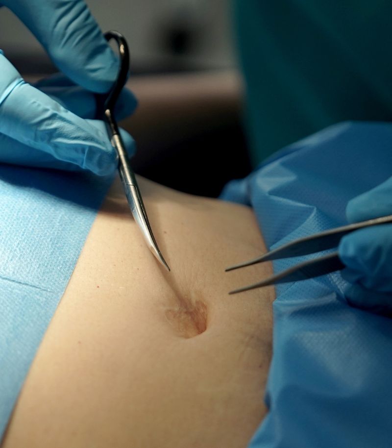 Liposucción quirúrgica para eliminar depósitos de grasa resistentes Liposucción quirúrgica para eliminar depósitos de grasa resistentes