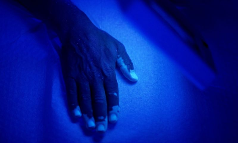 Dermatólogos especialistas en el tratamiento del vitíligo en Madrid - Clínicas en Calle Serrano y La Moraleja. Dermatólogos especialistas en el tratamiento del vitíligo en Madrid - Clínicas en Calle Serrano y La Moraleja.