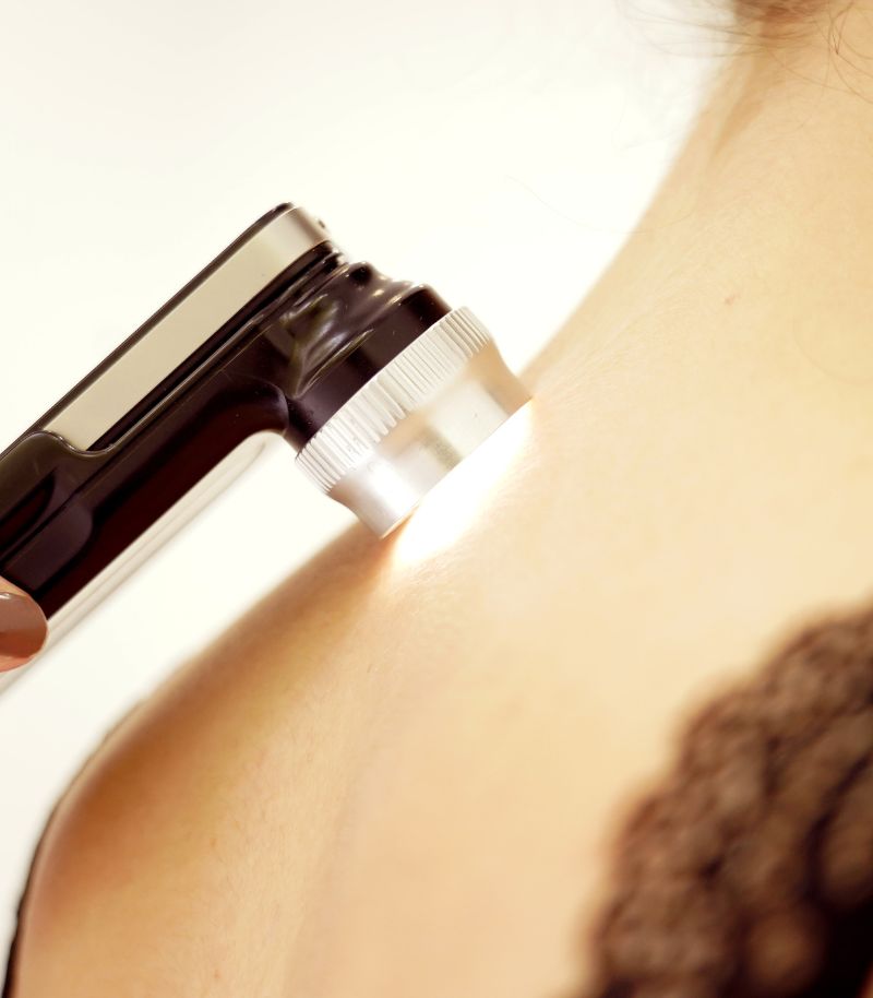 Diagnóstico temprano de la queratosis actínica Diagnóstico precoz de la queratosis actínica con dermatoscopia digital, Vectra 360 y microscopía confocal.