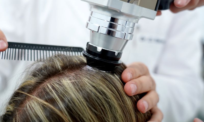 Especialistas en el tratamiento de la alopecia areata en Madrid - Clínicas en Calle Cinca y La Moraleja. Especialistas en el tratamiento de la alopecia areata en Madrid - Clínicas en Calle Cinca y La Moraleja.