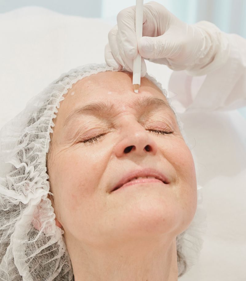 Lifting facial con sistemas de tensado cutáneo