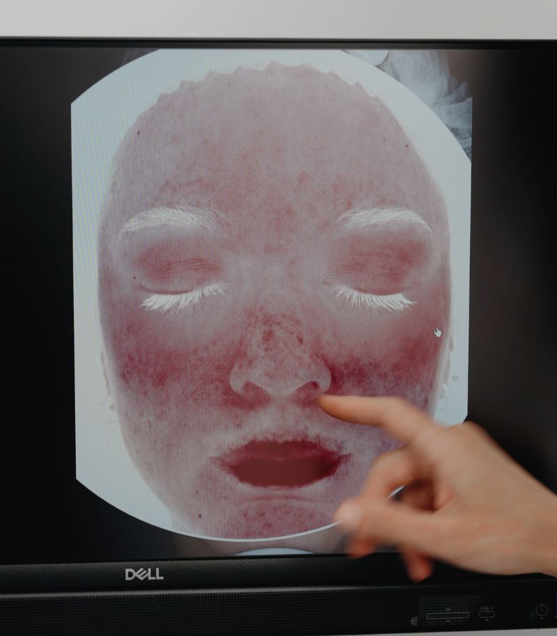 Análisis de la piel facial con Visia Análisis de la piel facial con Visia