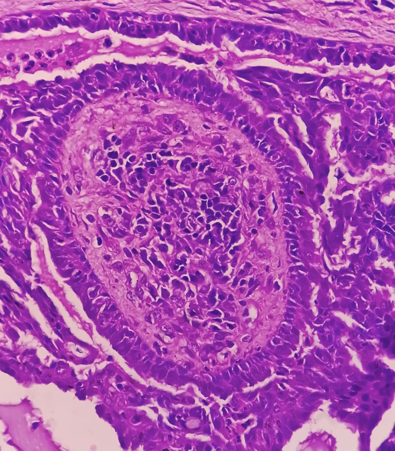 Biopsia dirigida mediante histeroscopia Biopsia dirigida del endometrio durante una histeroscopia diagnóstica