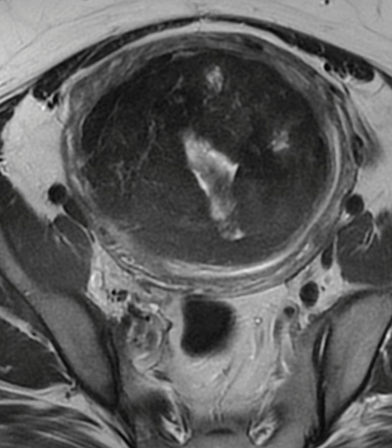 Tratamiento de pólipos y miomas mediante histeroscopia Histeroscopia quirúrgica para tratar pólipos endometriales y determinados miomas submucosos