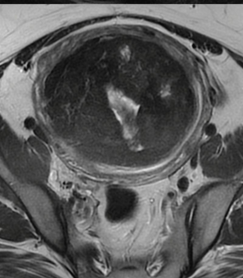 Reducción de miomas mediante radiofrecuencia Radiofrecuencia para reducir progresivamente el volumen de los miomas y sus síntomas