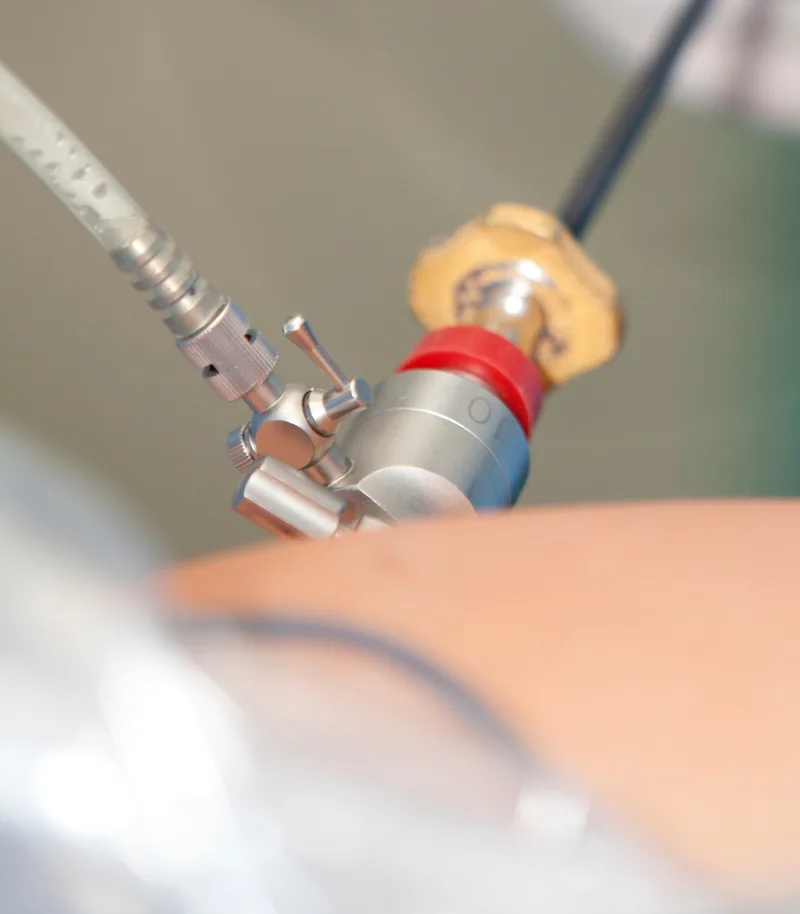 Cirugía de endometriosis y fertilidad Cirugía de endometriosis y fertilidad en pacientes con deseo de embarazo