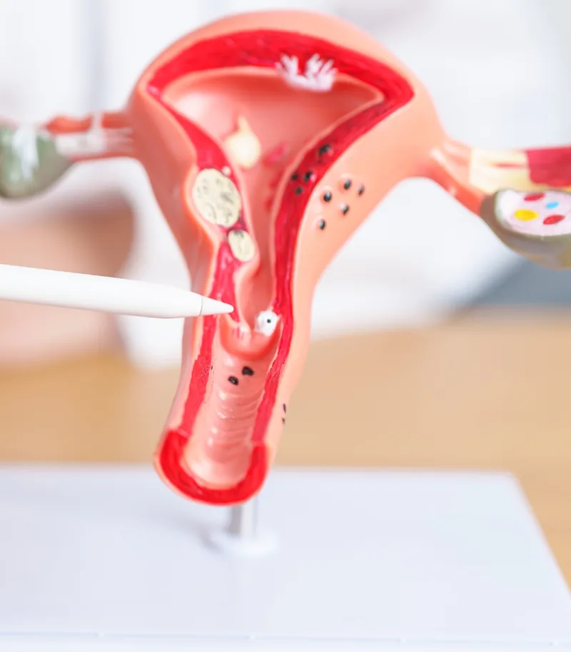 Planificación de la cirugía de endometriosis Planificación individualizada antes de una cirugía de endometriosis
